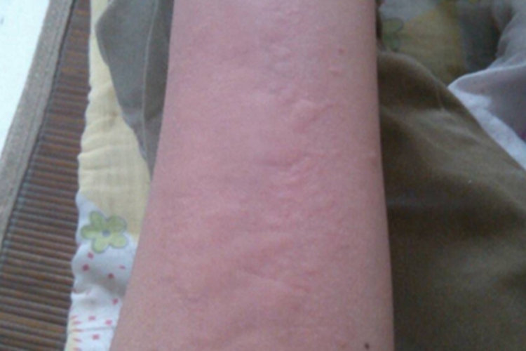 日光性荨麻疹胳膊症状图