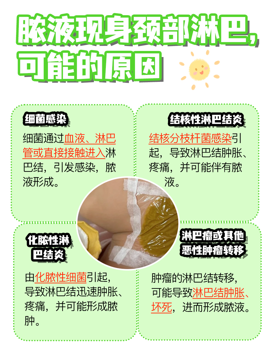 脓液现身颈部淋巴，是何信号？