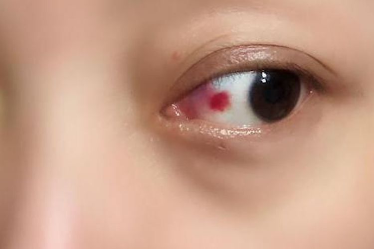 球结膜下出血红血点图 球结膜下出血红血点图