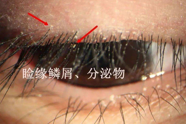 眼睫毛根部接触性睑皮炎图