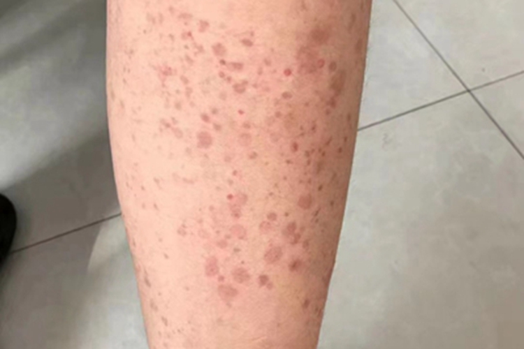 过敏性皮炎小腿长斑图