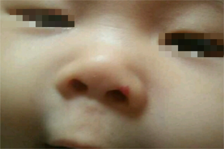 婴儿面部鼻子上红胎记图
