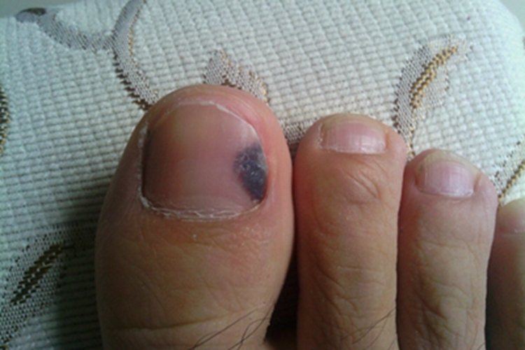 肢端雀斑痣样黑素瘤脚趾甲症状图 肢端雀斑痣样黑素瘤脚趾甲症状图