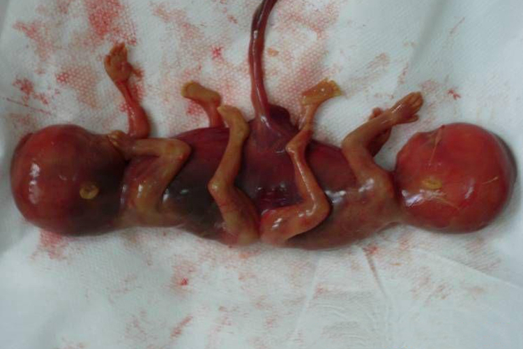 孕11周引产联体双胎正面图