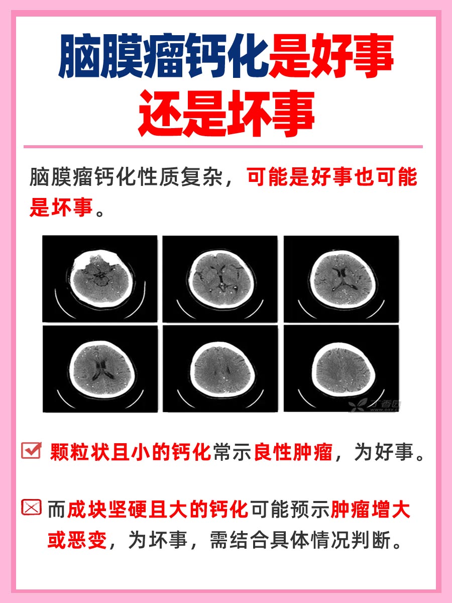 了解——脑膜瘤钙化是好事还是坏事?