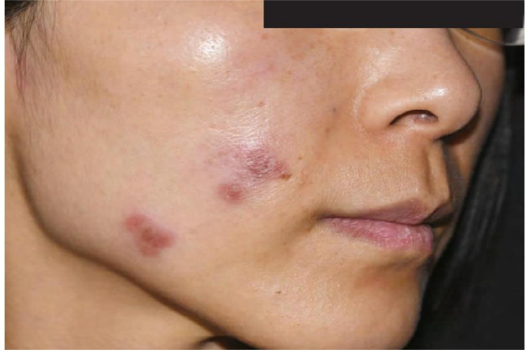 红斑狼疮早期红斑图