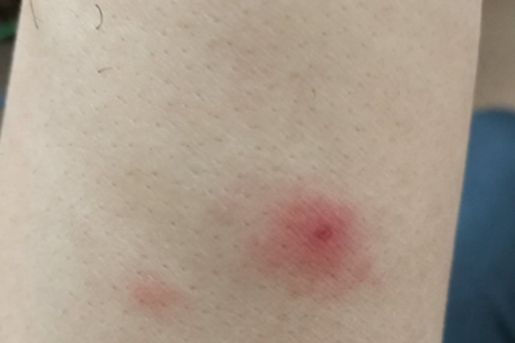 蜘蛛蜇伤小红点图