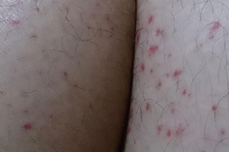 艾滋病急性感染期小腿症状图