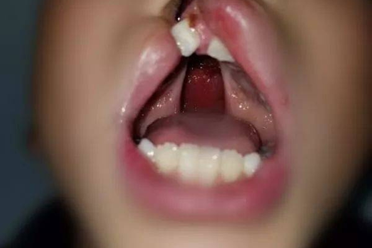 单侧三度唇腭裂图