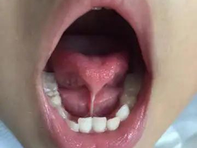 舌系带过短拉扯舌头图.jpg