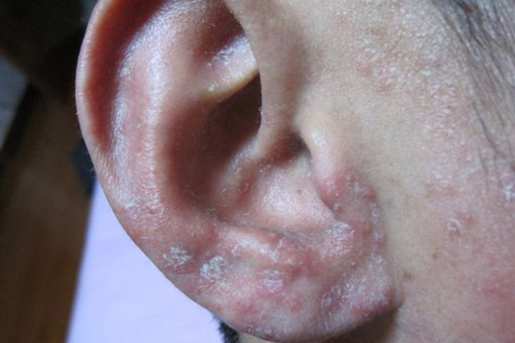 皮肤干燥伴鳞屑图