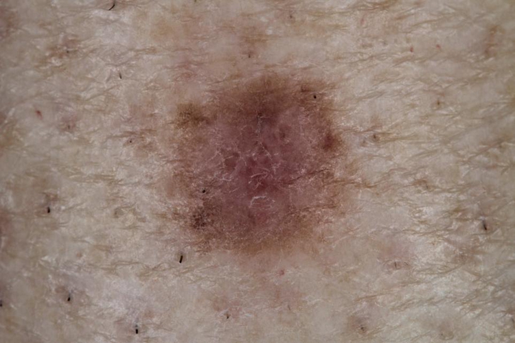 血卟啉病皮肤瘢痕图