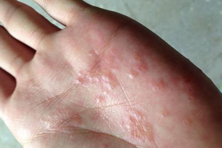 柯萨奇湿疹手掌症状图