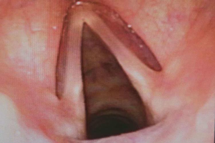 宝宝正常喉咙图 宝宝正常喉咙图