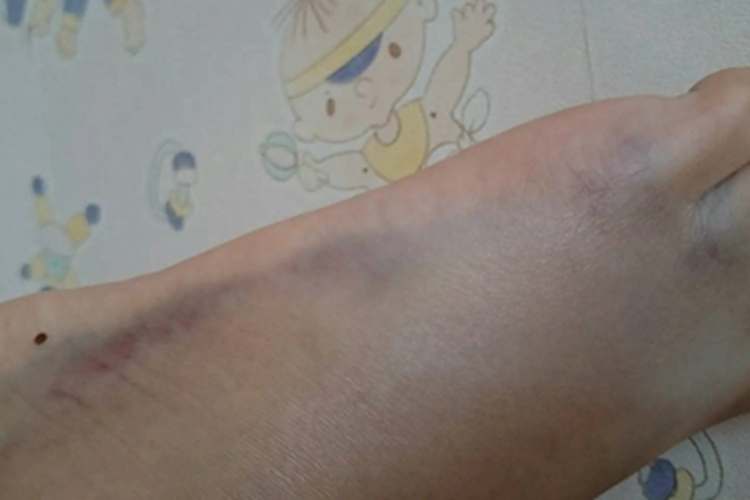 瘀斑脚侧面青了一条图
