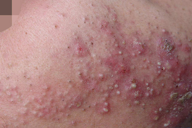 闭口比较严重图