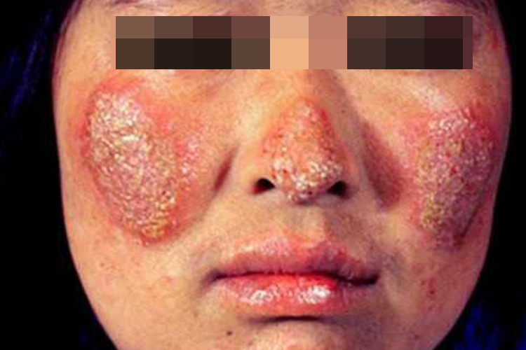 面部丘疹鳞屑型红斑图