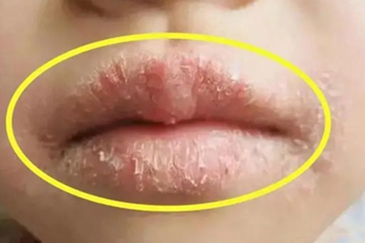 川崎病嘴唇干裂起皮图 川崎病嘴唇干裂起皮图