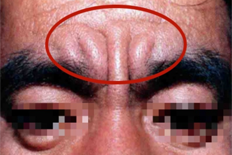 原发性骨膜增生厚皮症皮肤增厚图