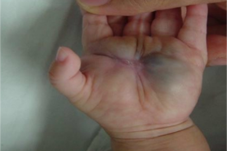 静脉畸形手掌症状图