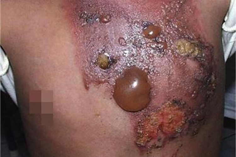 深Ⅱ度烧伤胸部红斑图 深Ⅱ度烧伤胸部红斑图