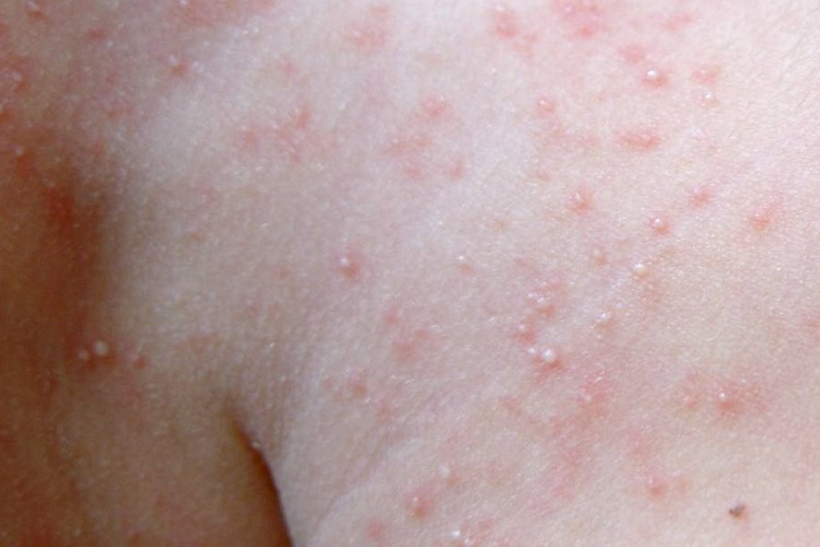 痱子臀部小水疱图