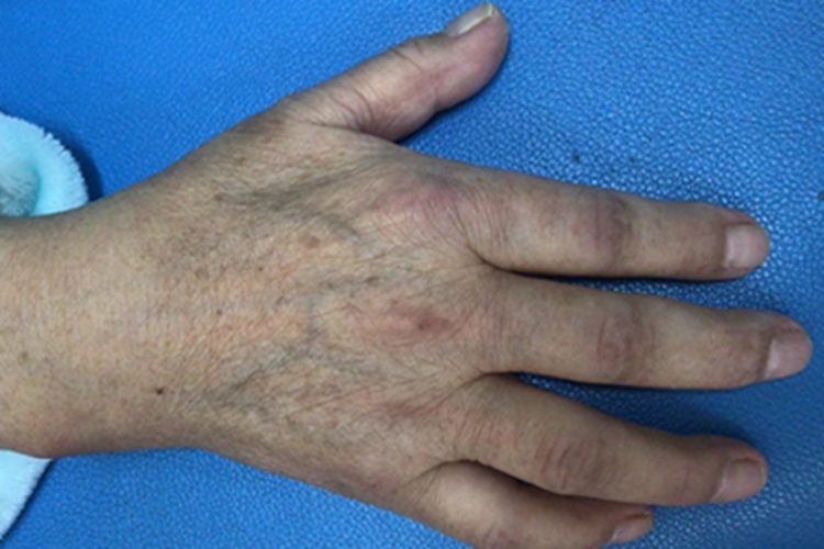 肩手综合征手指肿图