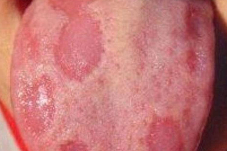 地图舌舌头红色斑块图