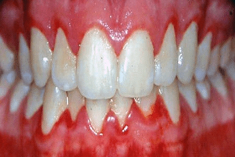 牙龈萎缩牙龈红肿充血图