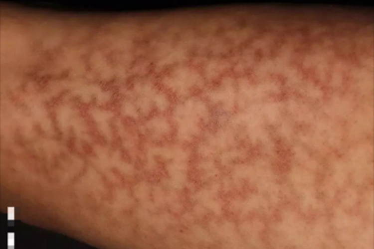 继发性网状青斑图 继发性网状青斑图