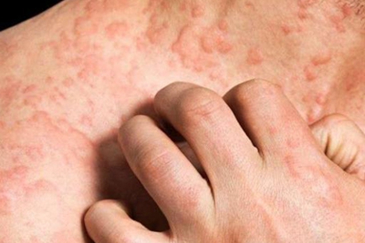 特应性皮炎颈部疙瘩图