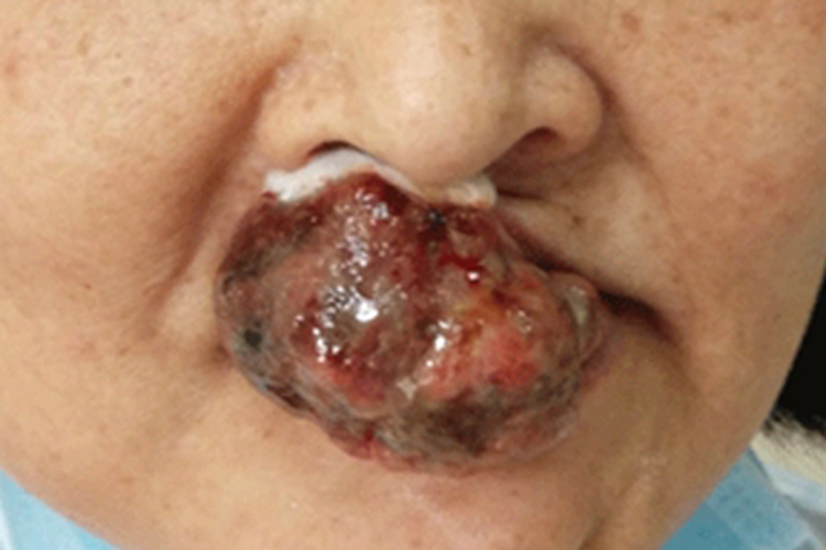 口腔颌面部恶性黑色素瘤症状图