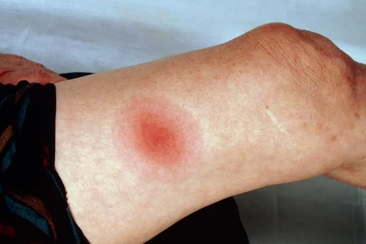 莱姆病早期游走性红斑图