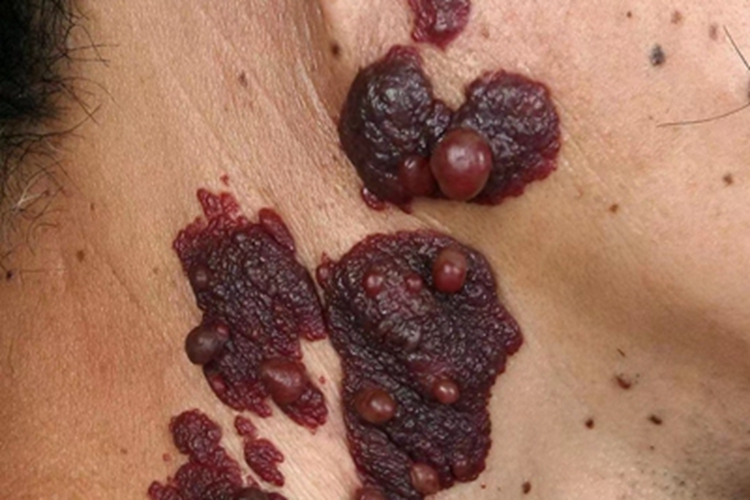 局限性血管角化瘤症状图