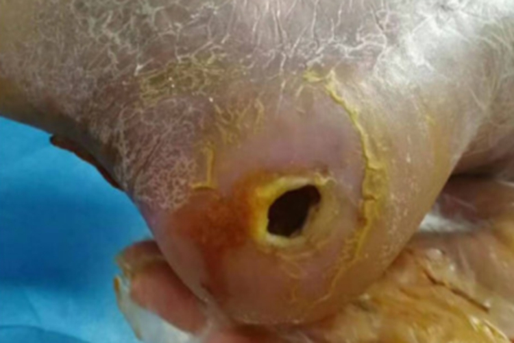 Ⅱ级糖尿病足症状图