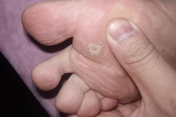寻常疣脚底有白色斑块图