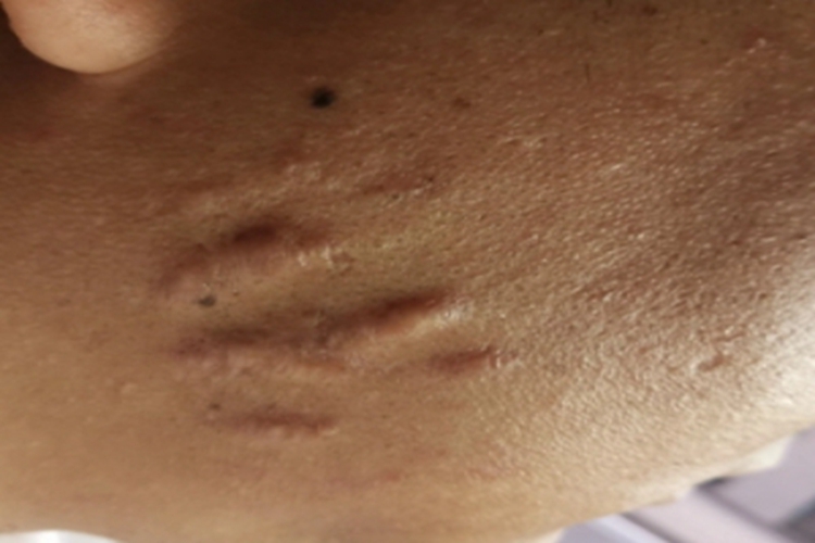 瘢痕疙瘩脸上形成几条瘢痕图