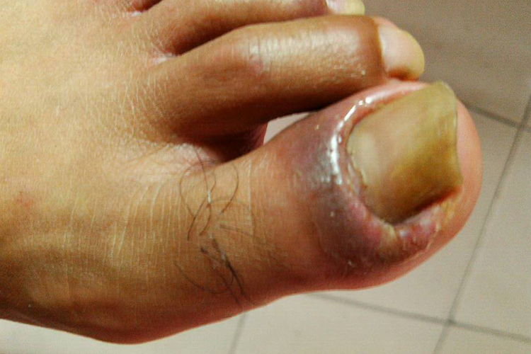 外伤感染脚趾坏死初期图