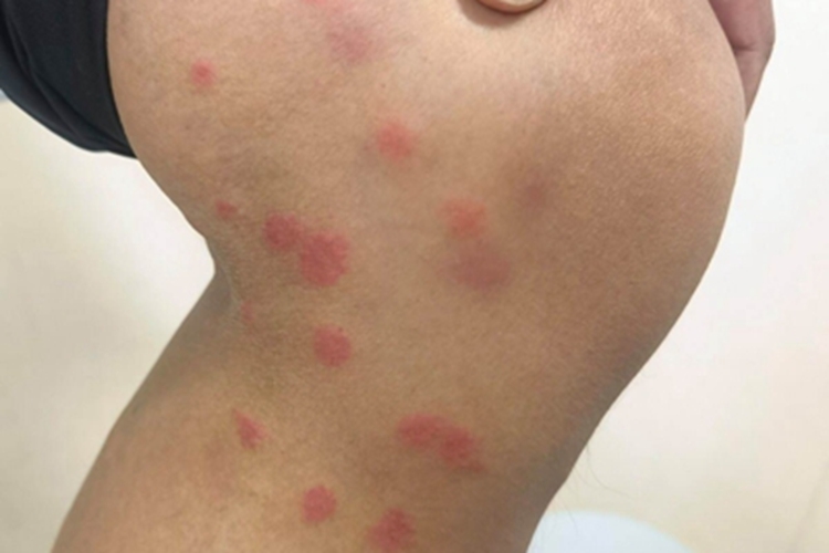 钩虫皮炎膝盖症状图