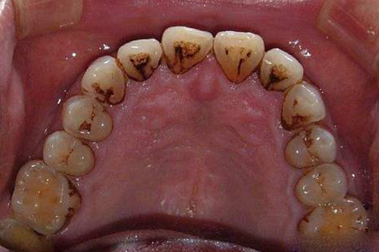牙结石指数2度图 牙结石指数2度图