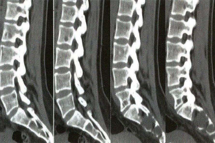腰骶椎矢状位后处理图