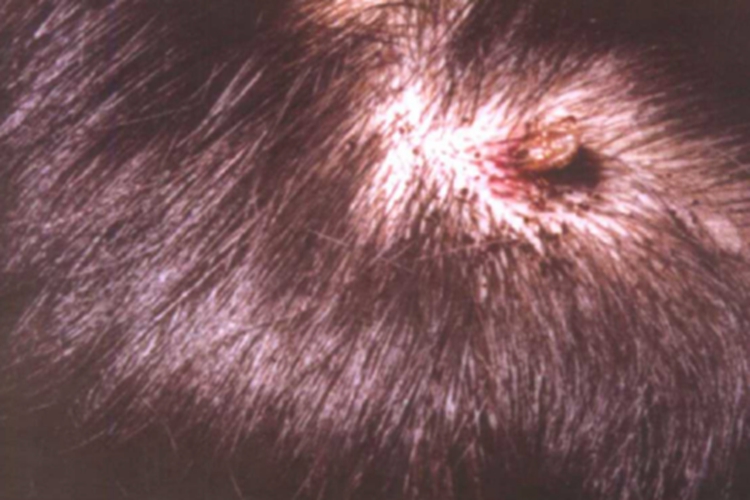 蜱咬伤头皮症状图