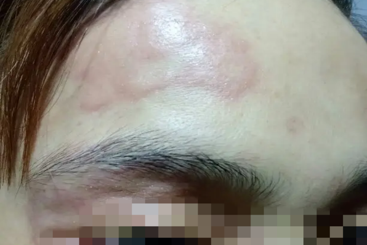 脸上荨麻疹图