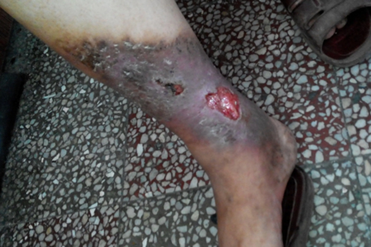 静脉曲张性溃疡图