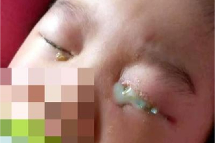 儿童结膜炎眼睛流脓图 儿童结膜炎眼睛流脓图