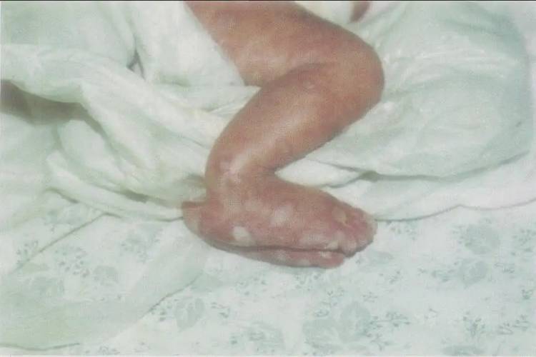 新生儿梅毒疹 新生儿梅毒疹