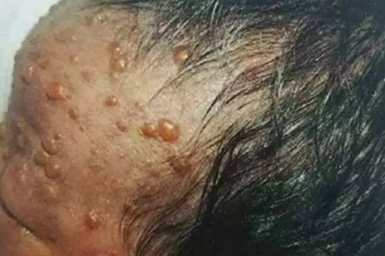 新生儿脓疱疮前额症状图