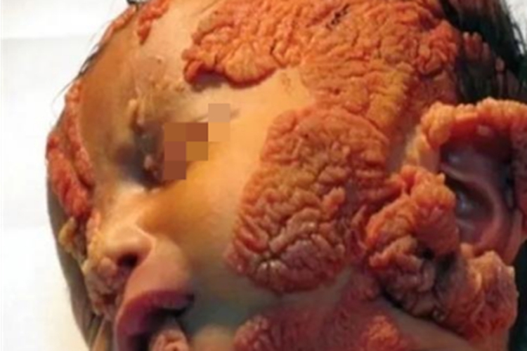 皮脂腺痣面部凸起疙瘩图 皮脂腺痣面部凸起疙瘩图