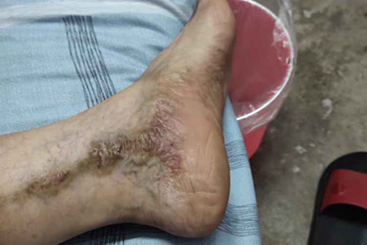 慢性湿疹脚踝内侧灰褐色斑图 慢性湿疹脚踝内侧灰褐色斑图