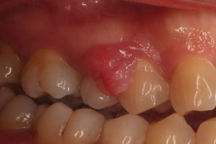 牙龈瘤红色肉疙瘩图